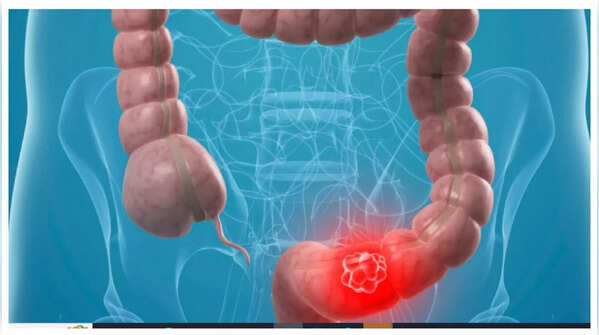 Illustration showing abdominal pain, a potential indicator of colon cancer
