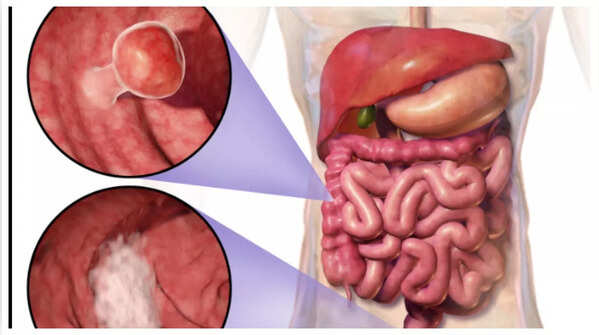 Image depicting blood in stool, a crucial symptom to watch for