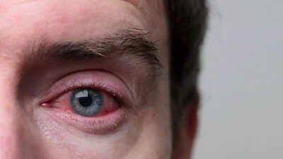 Blood in the eye: Should you be concerned about that red patch?
